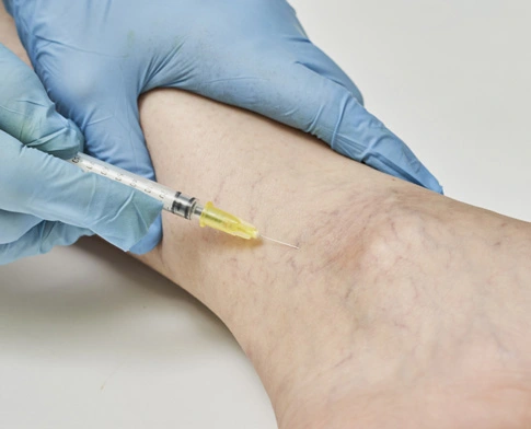 img-escleroterapia-com-espuma-tratamentos-para-varizes-cardioadvance