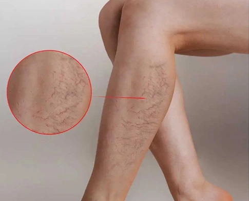 img-escleroterapia-convencional-tratamentos-para-varizes-cardioadvance